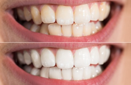 Lo que siempre te has preguntado sobre blanqueamiento dental -   