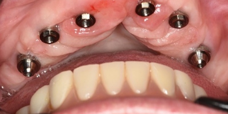 Foto de caso clinico de implantes subperiósticos para protesis dental fija atornillada